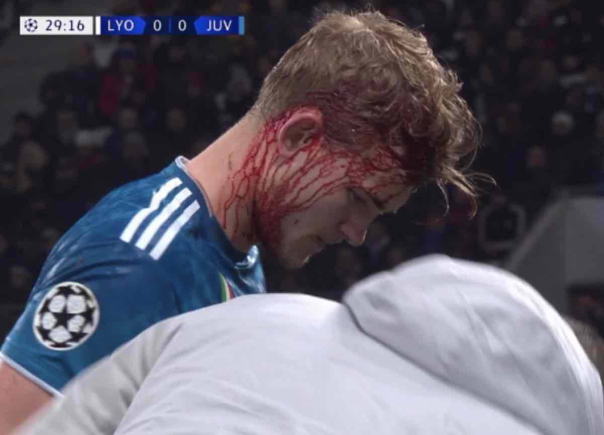 Sangue al volto per De Ligt